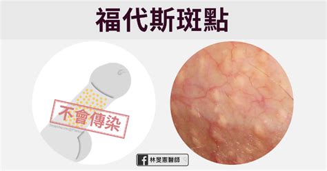 陰莖長息肉|包皮長一粒一粒東西？5 種「陰莖顆粒」可能成因解析，不一定是。